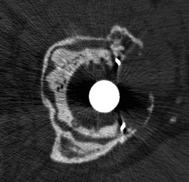 Revision THR Contained Defect Cup CT